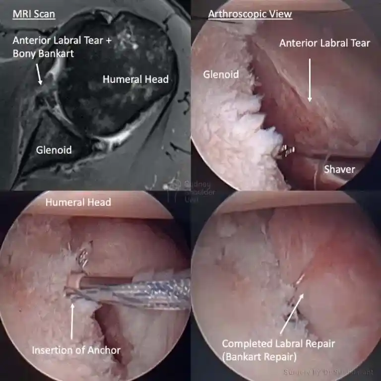 Labral repair imaging case study