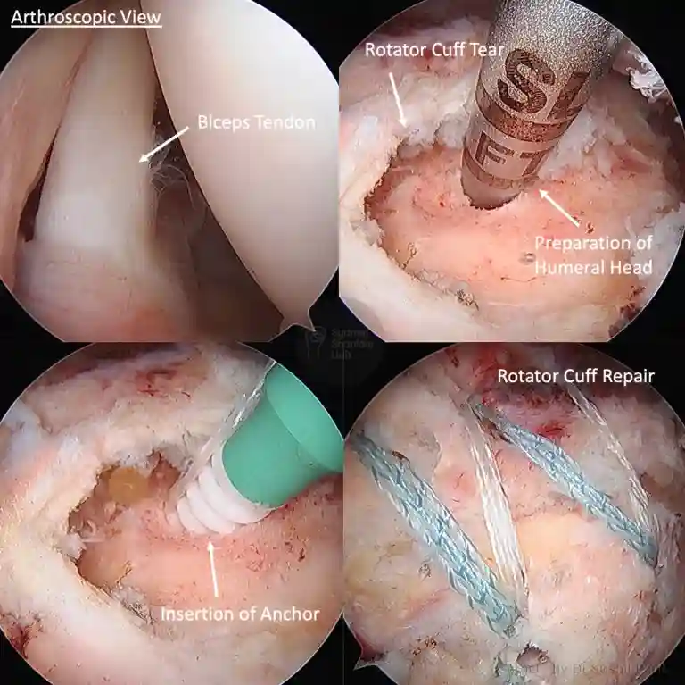Rotator cuff repair and biceps tenodesis case study