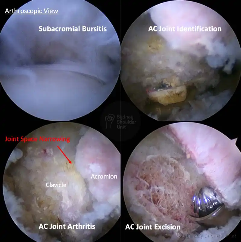 AC joint arthritis and excision imaging case study