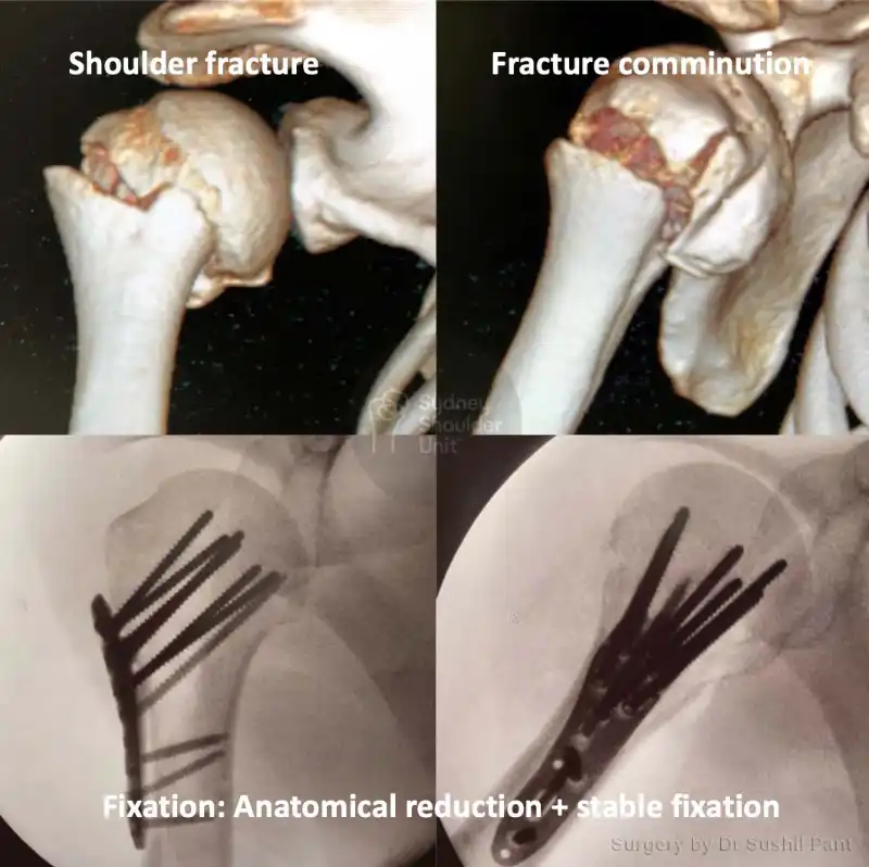 Proximal humerus fracture fixation imaging case study