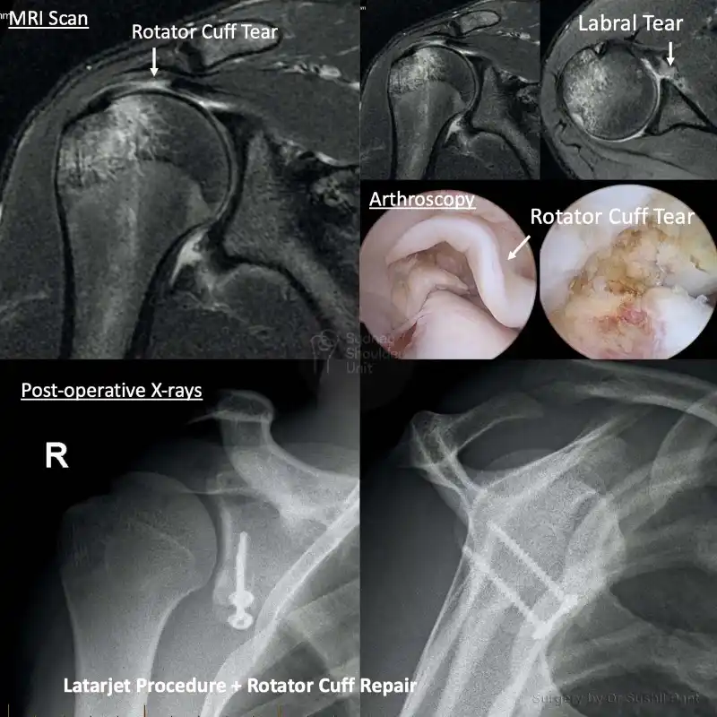 Latarjet procedure imaging case study