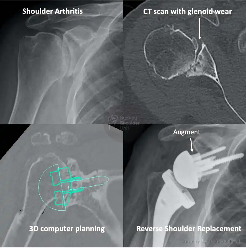 Reverse shoulder replacement imaging case study